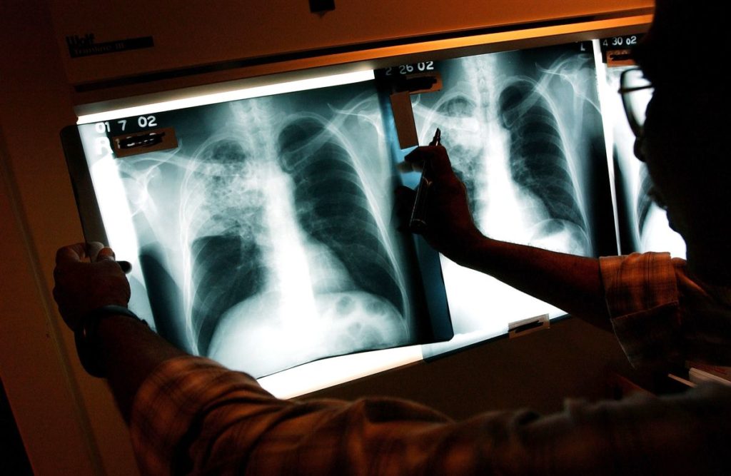 Singapore Widens Tuberculosis Checks After Large Cluster Emerges