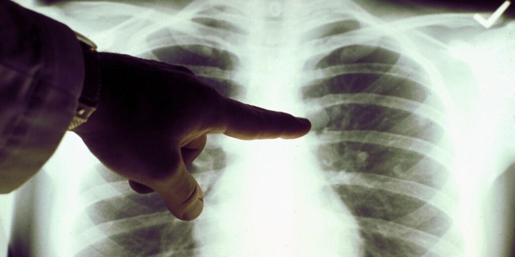 Living With Climate Change: Non-smoking lung cancer is on the rise. Blame pollution, says American Lung Association.